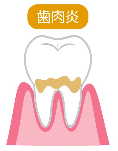 歯肉炎